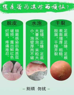 孕期长脚气(孕妇的脚气怎么治?可以抹什么脚气膏) 第2张 孕期长脚气(孕妇的脚气怎么治?可以抹什么脚气膏) 第2张