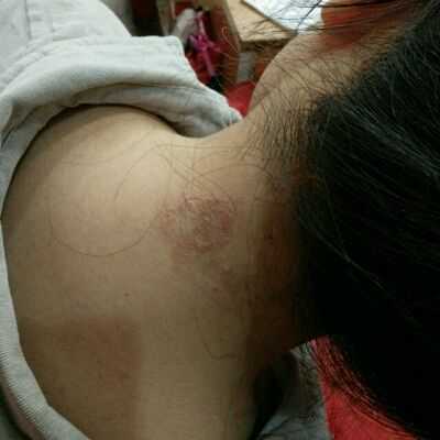 孕期脖子过敏(孕期脖子过敏非常痒怎么办) 第2张 孕期脖子过敏(孕期脖子过敏非常痒怎么办) 第2张