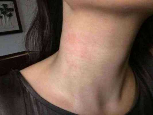 孕期脖子过敏(孕期脖子过敏非常痒怎么办) 第1张 孕期脖子过敏(孕期脖子过敏非常痒怎么办) 第1张
