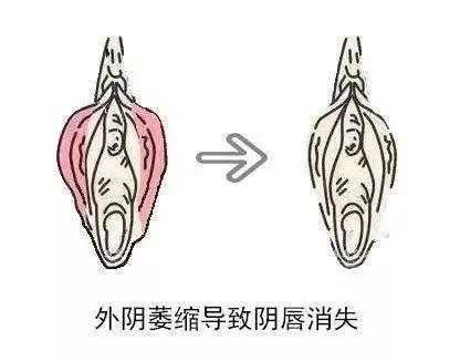 得了外阴白斑需要做手术吗, 第1张 得了外阴白斑需要做手术吗, 第1张