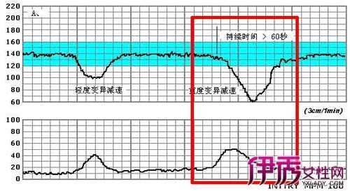 轻松识别胎儿监护图(轻松识别胎儿监护图pdf) 第1张 轻松识别胎儿监护图(轻松识别胎儿监护图pdf) 第1张