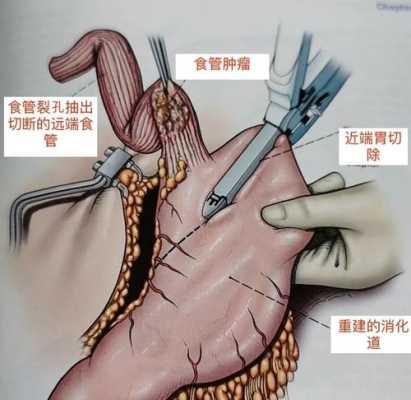 孕晚期胎儿往上顶(食道癌胃癌做完手术吃东西往上顶气怎么回事) 第3张 孕晚期胎儿往上顶(食道癌胃癌做完手术吃东西往上顶气怎么回事) 第3张