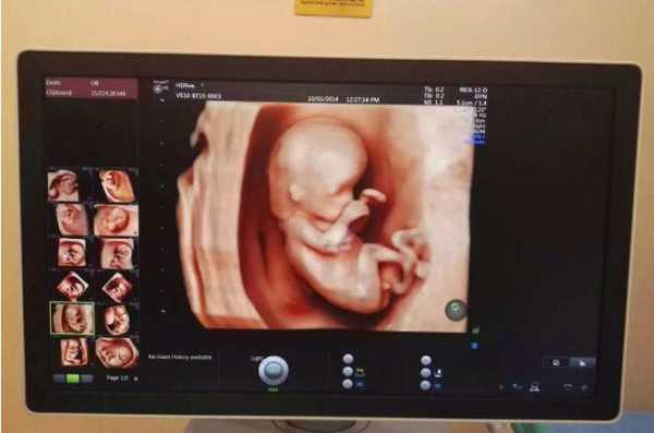 孕期检查数据(四维彩超hc是什么意思呢?是看什么的呢) 第2张 孕期检查数据(四维彩超hc是什么意思呢?是看什么的呢) 第2张