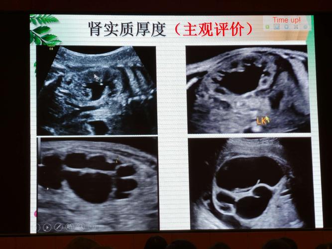 胎儿肾盂分离做了引产（胎儿肾盂分离做了引产有影响吗）  第1张