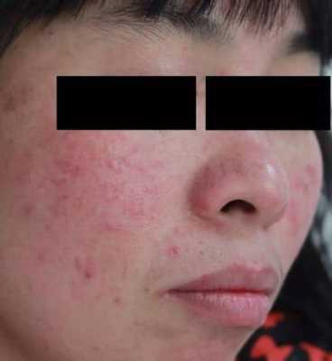 请问玫瑰痤疮怎么治疗,孕期玫瑰痤疮复发怎么办 第1张 请问玫瑰痤疮怎么治疗,孕期玫瑰痤疮复发怎么办 第1张
