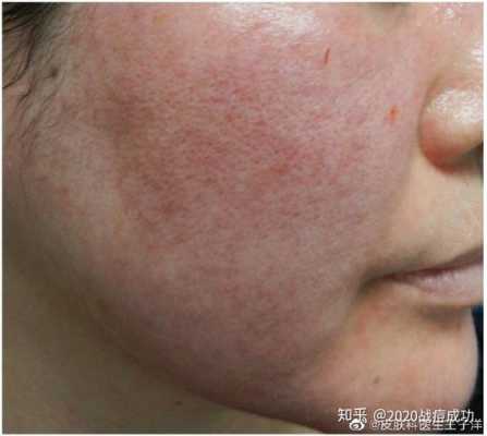 请问玫瑰痤疮怎么治疗,孕期玫瑰痤疮复发怎么办 第2张 请问玫瑰痤疮怎么治疗,孕期玫瑰痤疮复发怎么办 第2张