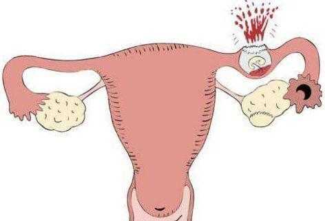 孕期出血腹痛(怀孕肚子疼流血是怎么回事) 第2张 孕期出血腹痛(怀孕肚子疼流血是怎么回事) 第2张
