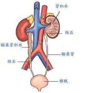 胎儿左肾重复肾畸形怎么办,胎儿肾脏畸形最常见的是 第2张 胎儿左肾重复肾畸形怎么办,胎儿肾脏畸形最常见的是 第2张