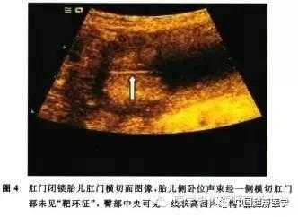 胎儿肛门闭锁超声图像（胎儿肛门闭锁超声图像）  第2张