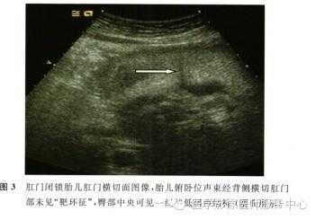 胎儿肛门闭锁超声图像（胎儿肛门闭锁超声图像）  第1张