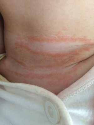 孕妇怎么预防胎儿湿疹(怀孕了长湿疹怎么办) 第3张 孕妇怎么预防胎儿湿疹(怀孕了长湿疹怎么办) 第3张