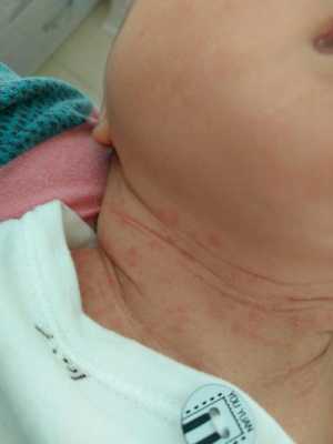孕妇怎么预防胎儿湿疹(怀孕了长湿疹怎么办) 第1张 孕妇怎么预防胎儿湿疹(怀孕了长湿疹怎么办) 第1张