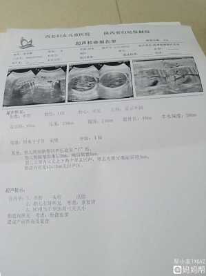 胎儿右肾囊性回声(胎儿右肾囊性回声) 第2张 胎儿右肾囊性回声(胎儿右肾囊性回声) 第2张