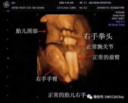 骨折都有哪些表现,胎儿骨折有什么症状表现 第3张 骨折都有哪些表现,胎儿骨折有什么症状表现 第3张