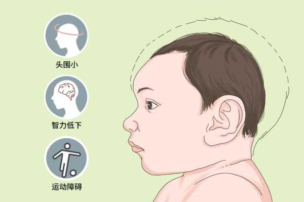 小头畸形的诊断标准是什么,如何排查胎儿小头畸形的原因 第2张 小头畸形的诊断标准是什么,如何排查胎儿小头畸形的原因 第2张