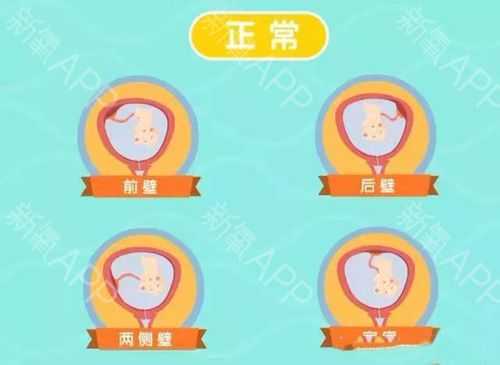 孕期前壁(着床于前壁及后壁啥意思) 第1张 孕期前壁(着床于前壁及后壁啥意思) 第1张