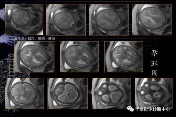 胎儿颅脑超声切面图(ct与磁共振有什么区别) 第3张 胎儿颅脑超声切面图(ct与磁共振有什么区别) 第3张