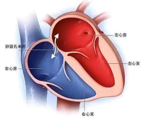 卵圆孔未闭怎么办?是不是新生儿都是闭合的,胎儿卵圆孔提前闭合与妊娠结局的临床分析 第2张 卵圆孔未闭怎么办?是不是新生儿都是闭合的,胎儿卵圆孔提前闭合与妊娠结局的临床分析 第2张