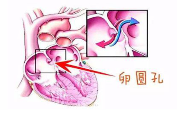 卵圆孔未闭怎么办?是不是新生儿都是闭合的,胎儿卵圆孔提前闭合与妊娠结局的临床分析 第3张 卵圆孔未闭怎么办?是不是新生儿都是闭合的,胎儿卵圆孔提前闭合与妊娠结局的临床分析 第3张
