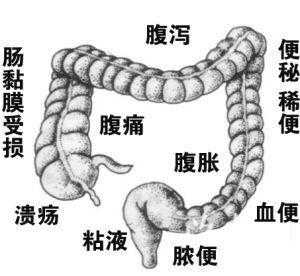 慢性肠炎能自愈吗,导致慢性肠炎的原因是,孕期慢性肠炎怎么办 第2张 慢性肠炎能自愈吗,导致慢性肠炎的原因是,孕期慢性肠炎怎么办 第2张