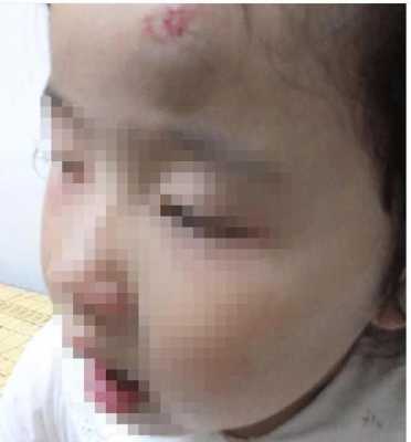 怀孕胎儿靠左边(3岁小孩孩子头左侧中部摔了个大包怎么办) 第2张 怀孕胎儿靠左边(3岁小孩孩子头左侧中部摔了个大包怎么办) 第2张