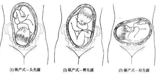 胎儿顶先露图片（宝宝衣服领子大露肩膀怎么缝）  第1张