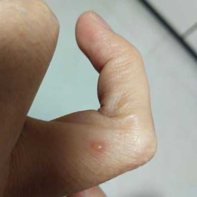 孕妇得水痘生下胎儿(孕妇得水痘生下胎儿) 第2张 孕妇得水痘生下胎儿(孕妇得水痘生下胎儿) 第2张