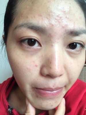 怀孕脸上长痘痘是什么原因,孕期痘印如何祛除 第3张 怀孕脸上长痘痘是什么原因,孕期痘印如何祛除 第3张
