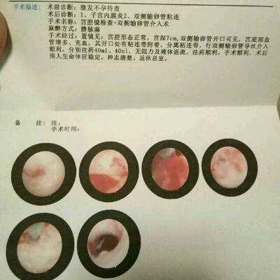 孕期出血宫腔有激液怎么办,孕期持续流血胎儿一切正常 第1张 孕期出血宫腔有激液怎么办,孕期持续流血胎儿一切正常 第1张