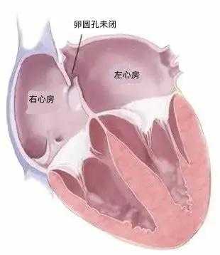 胎儿心脏房间隔卵圆孔(胎儿心脏房间隔卵圆孔3.3 mm) 第2张 胎儿心脏房间隔卵圆孔(胎儿心脏房间隔卵圆孔3.3 mm) 第2张