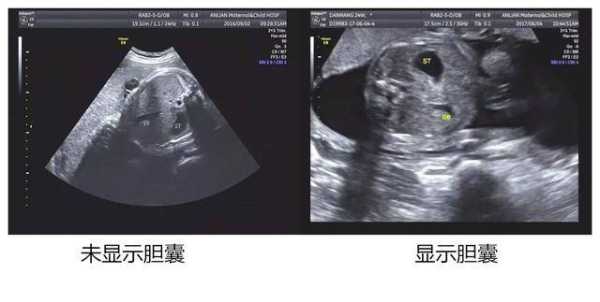 胎儿未见胆囊临床经验(胎儿未见胆囊临床经验) 第2张 胎儿未见胆囊临床经验(胎儿未见胆囊临床经验) 第2张
