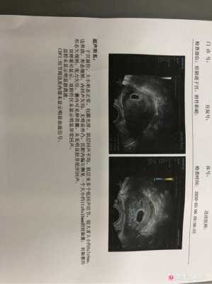 没胎心怎么办,胎儿没有胎心的表现有哪些 第2张 没胎心怎么办,胎儿没有胎心的表现有哪些 第2张