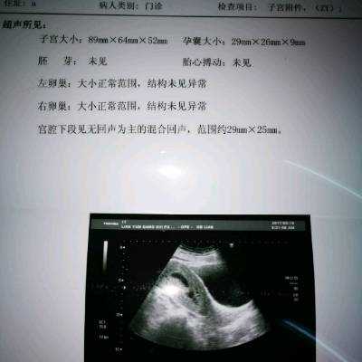 没胎心怎么办,胎儿没有胎心的表现有哪些 第1张 没胎心怎么办,胎儿没有胎心的表现有哪些 第1张