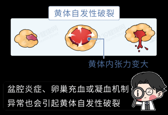 什么是黄体破裂,孕期黄体破裂是怎么回事 第2张 什么是黄体破裂,孕期黄体破裂是怎么回事 第2张