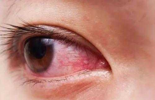 孕期眼睛发红(眼睛发红是什么病) 第3张 孕期眼睛发红(眼睛发红是什么病) 第3张