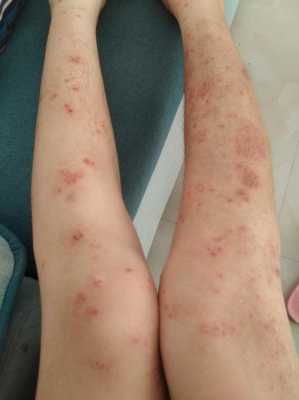 孕期手足湿疹(孕期手足湿疹太痒了怎么办) 第2张 孕期手足湿疹(孕期手足湿疹太痒了怎么办) 第2张