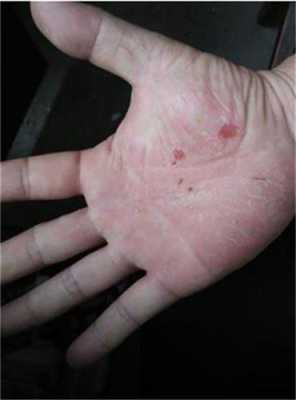 孕期手足湿疹(孕期手足湿疹太痒了怎么办) 第1张 孕期手足湿疹(孕期手足湿疹太痒了怎么办) 第1张