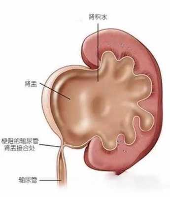 小孩腹腔积液是怎么回事,胎儿腹腔积液产生的原因有三 第2张 小孩腹腔积液是怎么回事,胎儿腹腔积液产生的原因有三 第2张