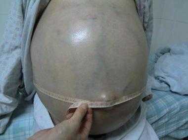 小孩腹腔积液是怎么回事,胎儿腹腔积液产生的原因有三 第1张 小孩腹腔积液是怎么回事,胎儿腹腔积液产生的原因有三 第1张