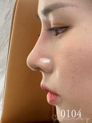 彭体隆鼻+耳软骨鼻尖一个月鼻头很硬正常么,孕期鼻子变硬怎么回事 第3张 彭体隆鼻+耳软骨鼻尖一个月鼻头很硬正常么,孕期鼻子变硬怎么回事 第3张