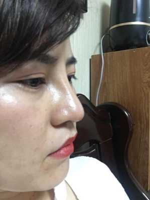 彭体隆鼻+耳软骨鼻尖一个月鼻头很硬正常么,孕期鼻子变硬怎么回事 第1张 彭体隆鼻+耳软骨鼻尖一个月鼻头很硬正常么,孕期鼻子变硬怎么回事 第1张