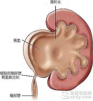 肾积水多少毫米算严重,胎儿肾积水多少不能要孩子 第2张 肾积水多少毫米算严重,胎儿肾积水多少不能要孩子 第2张