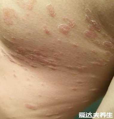 孕期玫瑰糠疹(玫瑰糠疹的治疗方法有哪些) 第1张 孕期玫瑰糠疹(玫瑰糠疹的治疗方法有哪些) 第1张
