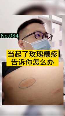 孕期玫瑰糠疹(玫瑰糠疹的治疗方法有哪些) 第3张 孕期玫瑰糠疹(玫瑰糠疹的治疗方法有哪些) 第3张