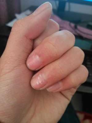 孕期指甲有白点(指甲上有白色斑点是怎么回事,指甲白斑原因) 第2张 孕期指甲有白点(指甲上有白色斑点是怎么回事,指甲白斑原因) 第2张