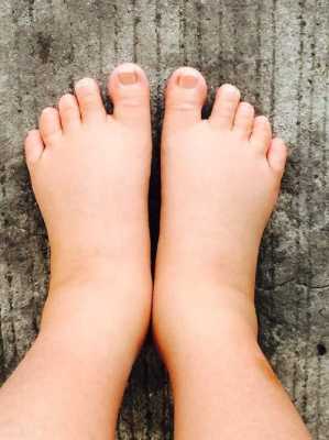 孕期怎么去水肿（孕妇的脚肿吃什么可以消肿）  第2张