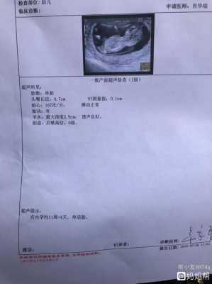 孕期nt检查时间(一般怀孕多久要做nt检查呢?需要多久时间) 第1张 孕期nt检查时间(一般怀孕多久要做nt检查呢?需要多久时间) 第1张