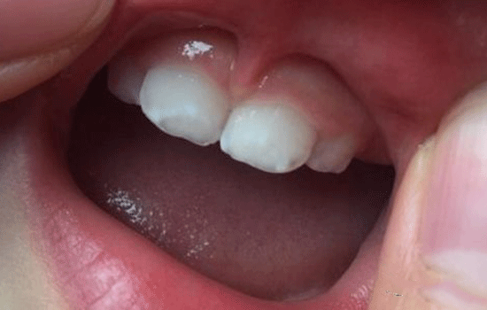 孕妇吃什么胎儿会白(宝宝牙齿有白斑怎么回事?白斑是什么原因引起的呢) 第3张 孕妇吃什么胎儿会白(宝宝牙齿有白斑怎么回事?白斑是什么原因引起的呢) 第3张