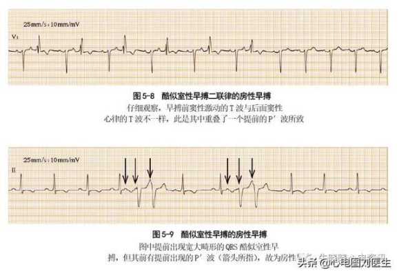 胎儿频发性早搏的危害(频发室性早搏严重吗?有危险吗) 第1张 胎儿频发性早搏的危害(频发室性早搏严重吗?有危险吗) 第1张