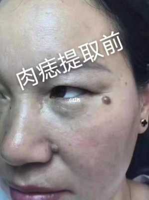 孕期脸上长疣(孕期脸上长疣怎么办) 第1张 孕期脸上长疣(孕期脸上长疣怎么办) 第1张